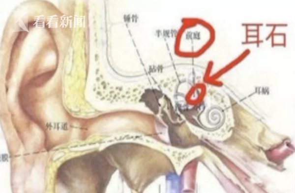 【失手了】用筋膜枪放松肌肉竟把自己打晕 检查竟是把耳石打下来了