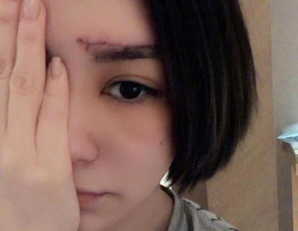 【触目惊心】阿娇晒伤口照片 在酒店房间究竟发生了什么? 