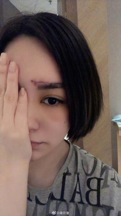 会毁容吗?阿娇首晒高清伤口照片 眉心到眉骨布满针眼