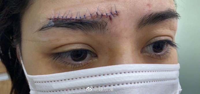 会毁容吗?阿娇首晒高清伤口照片 眉心到眉骨布满针眼