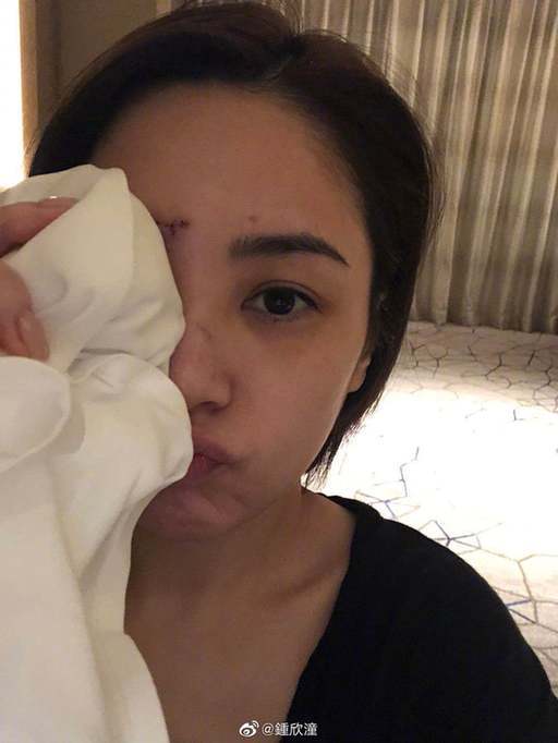 会毁容吗?阿娇首晒高清伤口照片 眉心到眉骨布满针眼