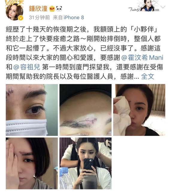 会毁容吗?阿娇首晒高清伤口照片 眉心到眉骨布满针眼