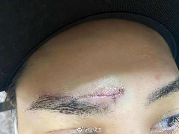 会毁容吗?阿娇首晒高清伤口照片 眉心到眉骨布满针眼