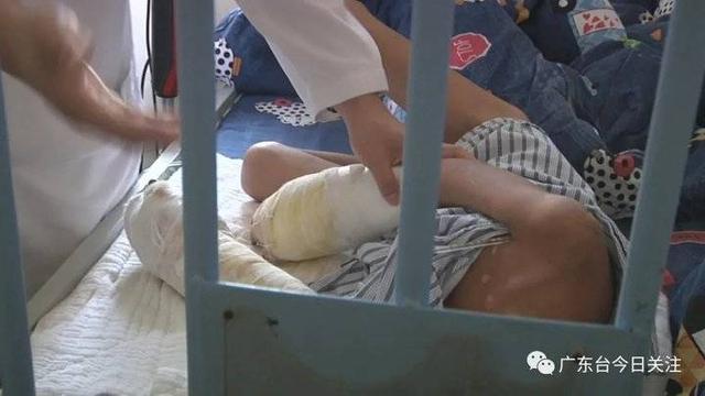 毫无人性!一男童遭亲父烟头烫伤双手面临截肢