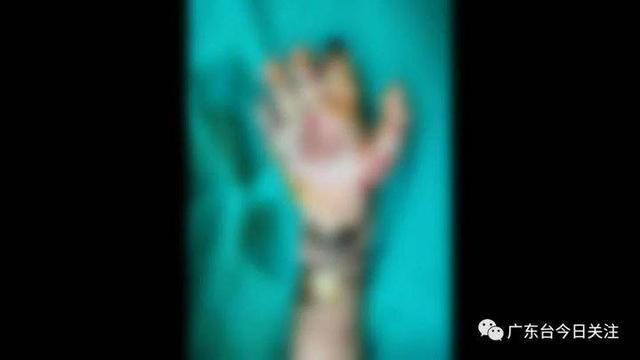 毫无人性!一男童遭亲父烟头烫伤双手面临截肢