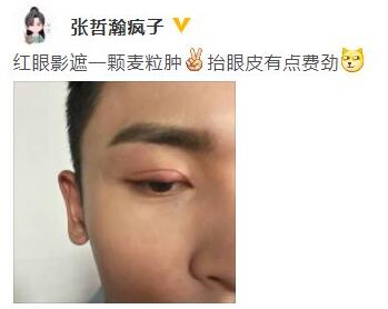 奇怪知识又增加了！专家说张哲瀚用眼影遮麦粒肿使不得
