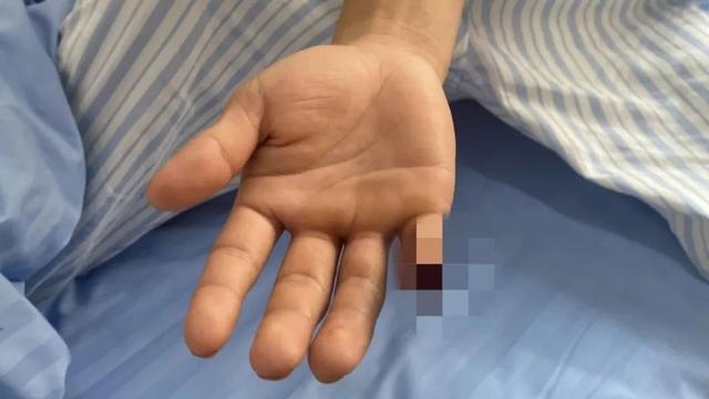 心疼!云南辅警抓偷渡蛇头被咬断手指 鲜血直流、骨肉可见…