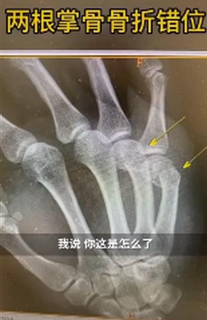 上海一爸爸辅导孩子作业，生气捶墙致骨折，网友：感同身受的“痛”