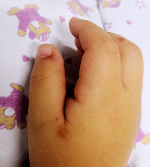 注意!广西手足口病进入高发期 托幼机构是流行重点区