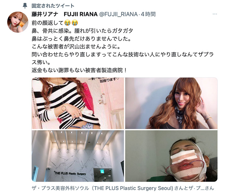 鼻子摇摇欲坠鼻尖不见了！藤井リアナ(藤井梨亚奈)整坏了！