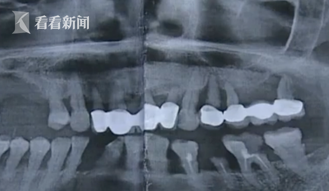 修复烤瓷牙却被拔3颗真牙?患者:医生只顾聊天(图)