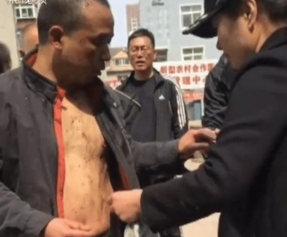 男子跳化粪池救人留后遗症怎么回事 救人者系退役军人称不后悔