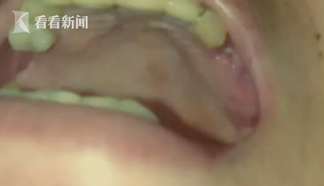 修复烤瓷牙却被拔3颗真牙?患者:医生只顾聊天(图)