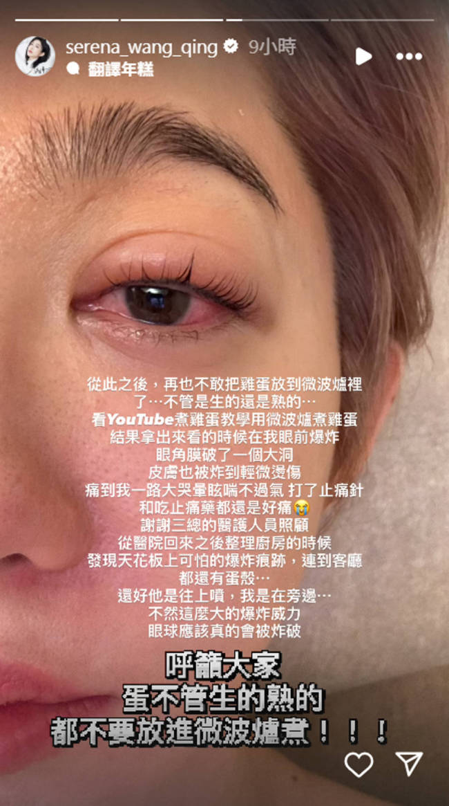 女演员微波炉煮鸡蛋被炸伤眼睛:眼角膜破了个大洞