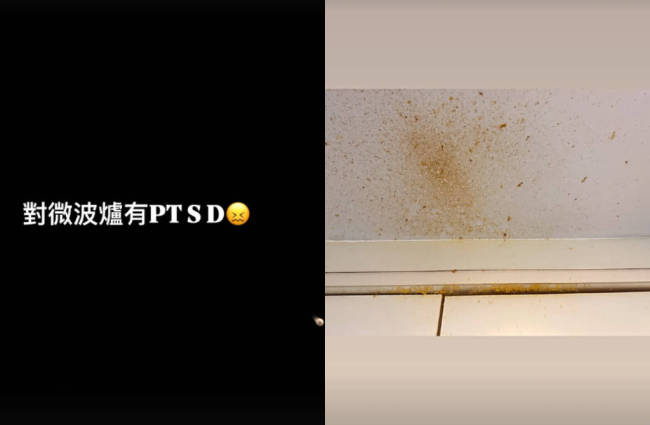 女演员微波炉煮鸡蛋被炸伤眼睛:眼角膜破了个大洞